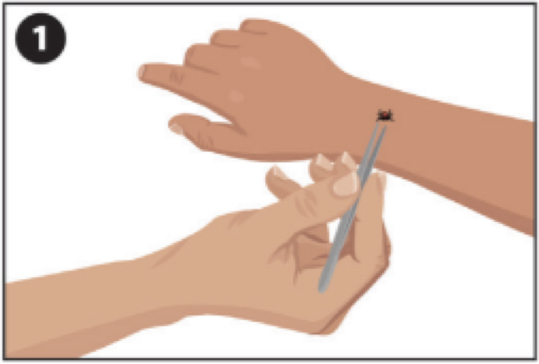 One hand is gripping a tick with a pair of tweezers on another hand.